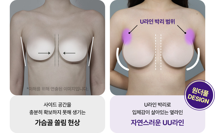 U라인 박리 가슴확대