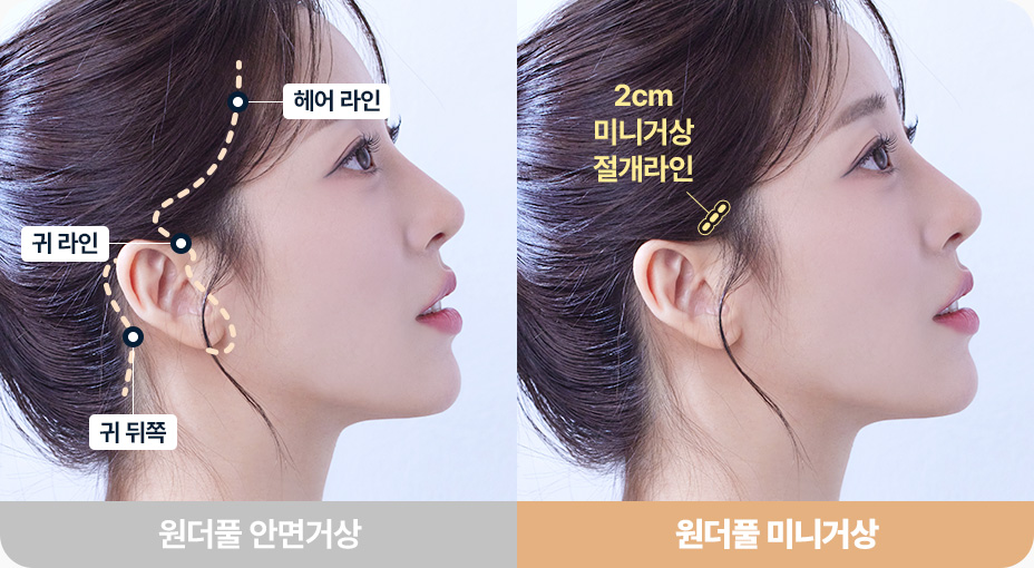 안면거상 4중리프팅 늘어진 유지인대 끊기 피부 진피 근막 근육층 4중으로 당겨 리프팅