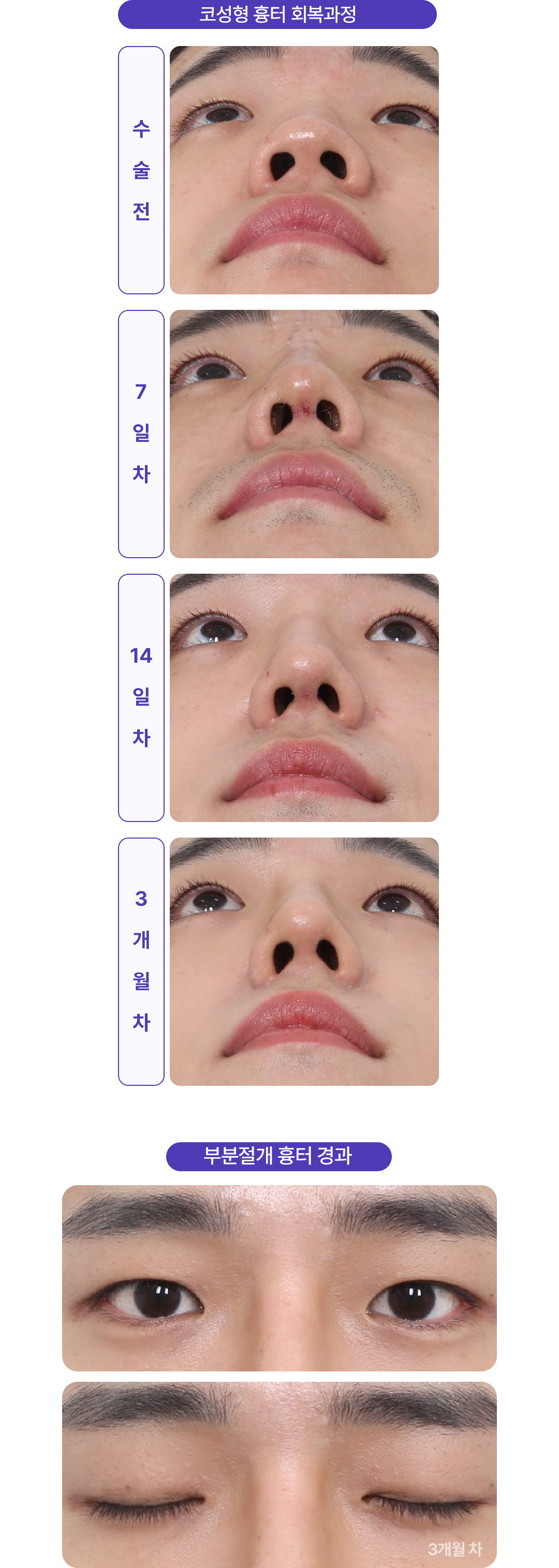 흉터 회복과정
