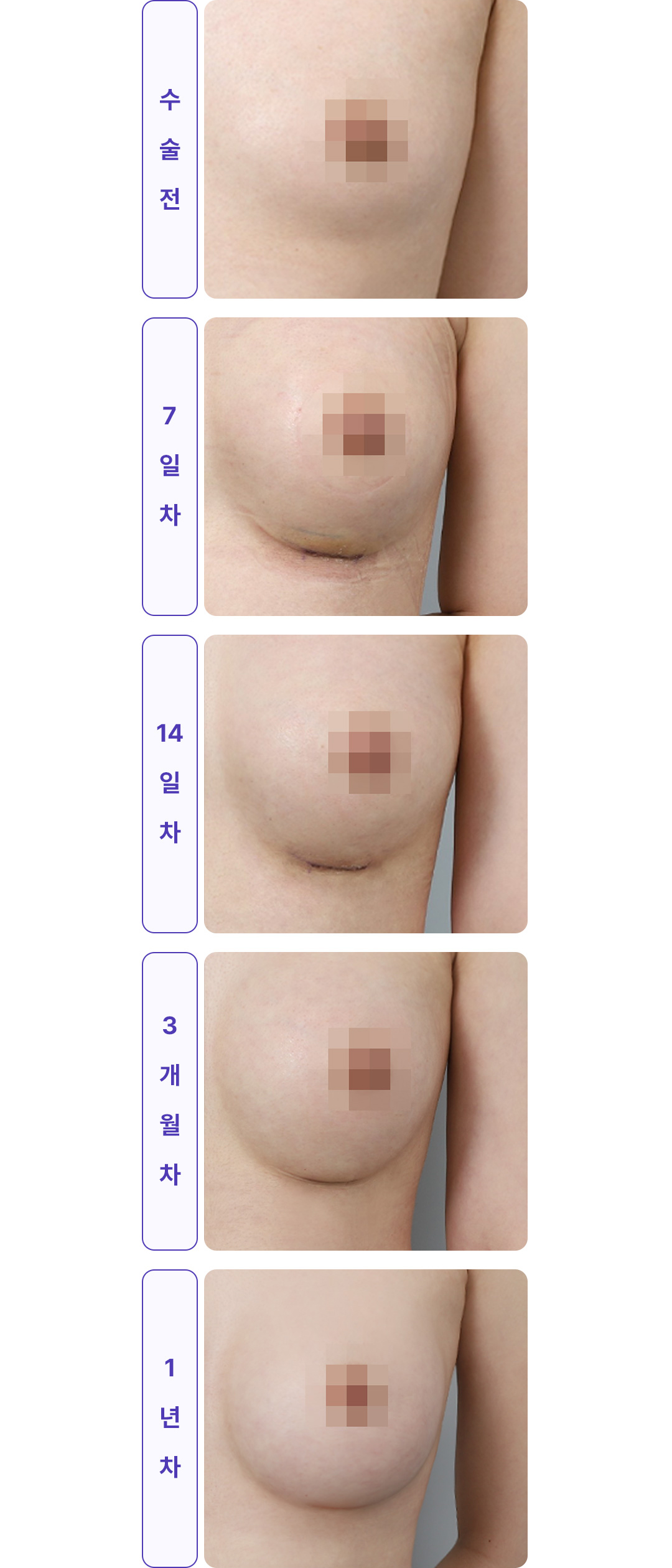흉터 회복과정