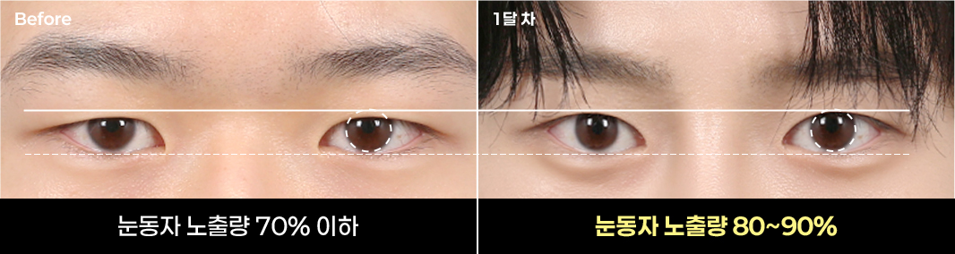 수술 전 눈동자 노출량 70% 이하, 1달 차 80~90%