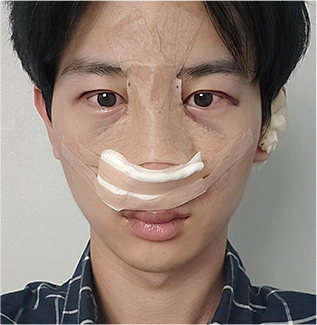 윤하 회복 기록 D+1