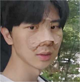 윤하 회복 기록 D+3 (솜 제거)