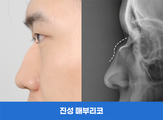 진성 매부리코