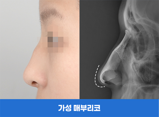 가성 매부리코