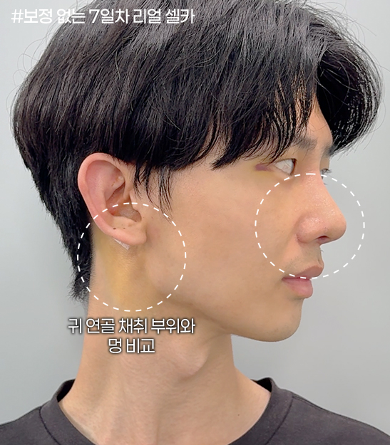 보정 없는 7일차 리얼 셀카, 귀 연골 채취 부위와 멍 비교