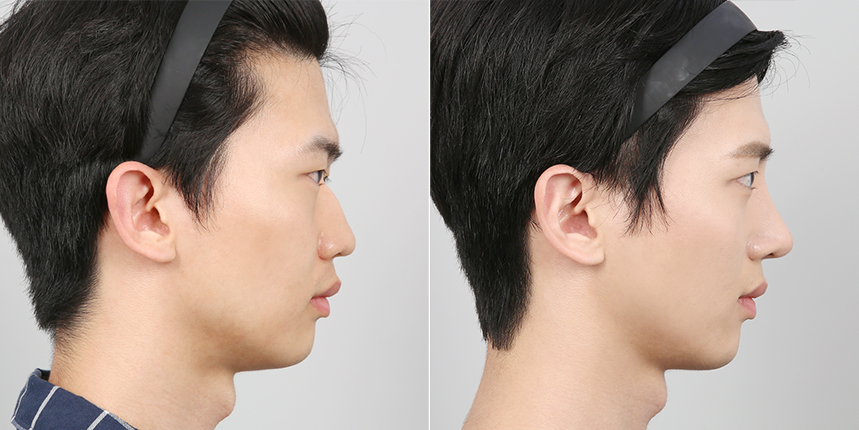 측면 수술 전후 비교