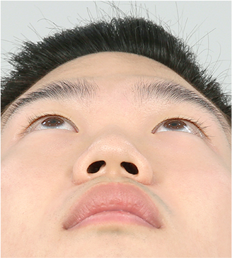 아래 수술 전