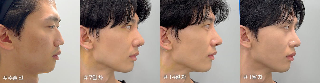 수술 전, 7일 차, 14일 차, 1달 차 옆모습