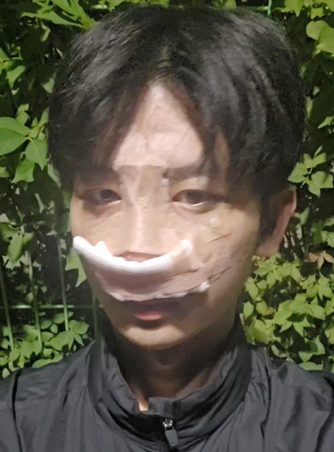 수술 후 회복 중 산책