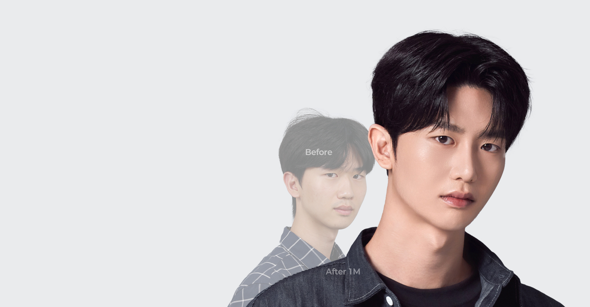 윤하 수술 전과 수술 1개월 후